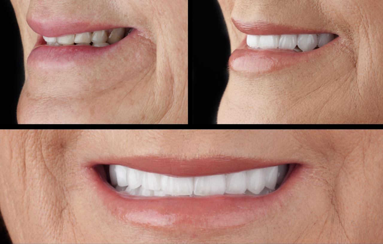 Antes e depois: recontorno gengival e lentes de contato