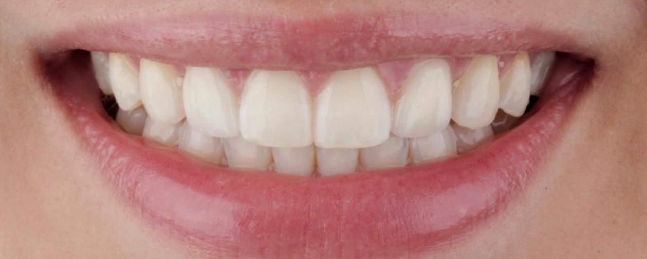 Antes e depois: lentes de contato em porcelana